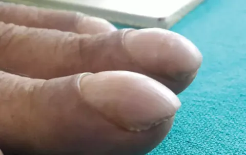 Alerta: Essa grande mudança nos dedos pode ser sinal de doen