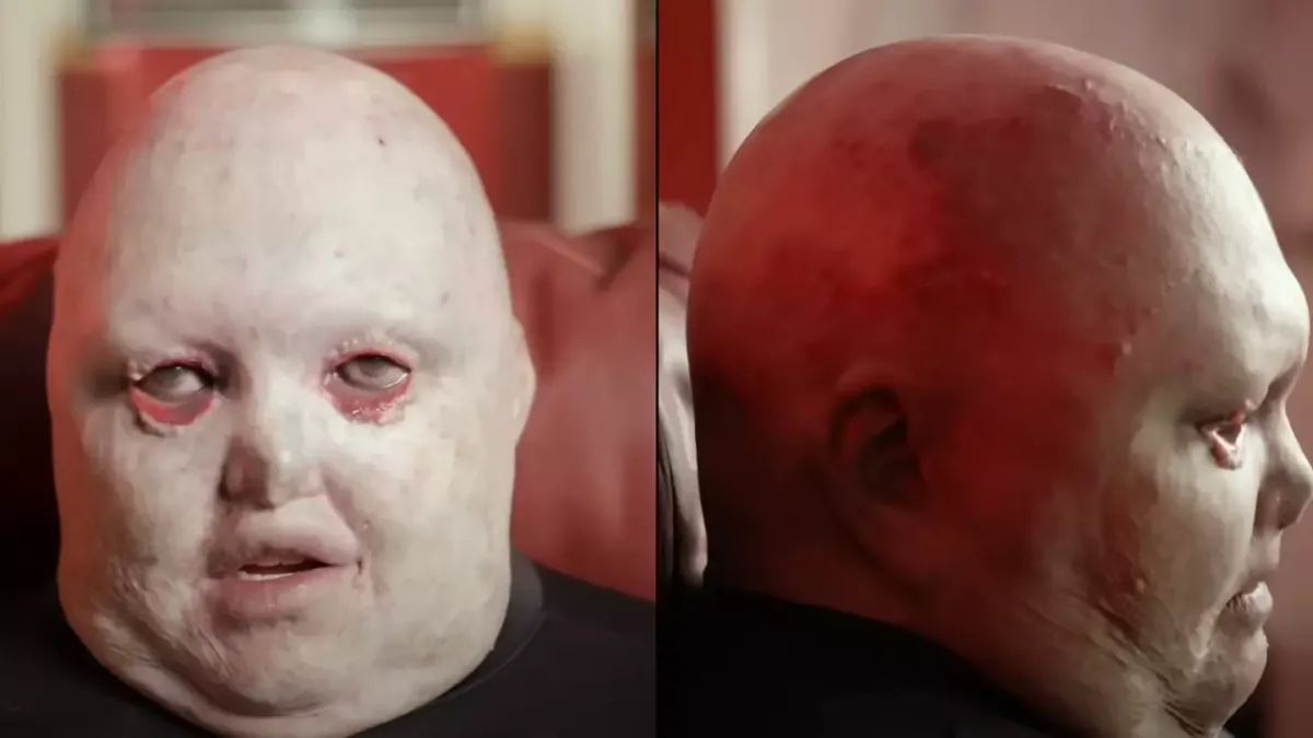 Dean Clifford: superando limites com epidermólise bolhosa