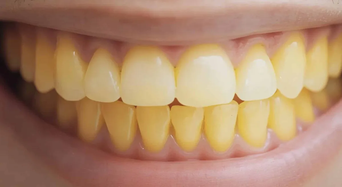 Dentista compartilha erro comum que muitas pessoas cometem e
