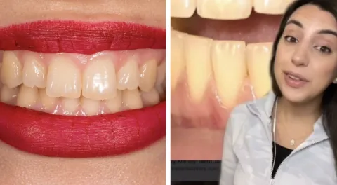 Dentista explica por que seus dentes ficam amarelos mesmo qu