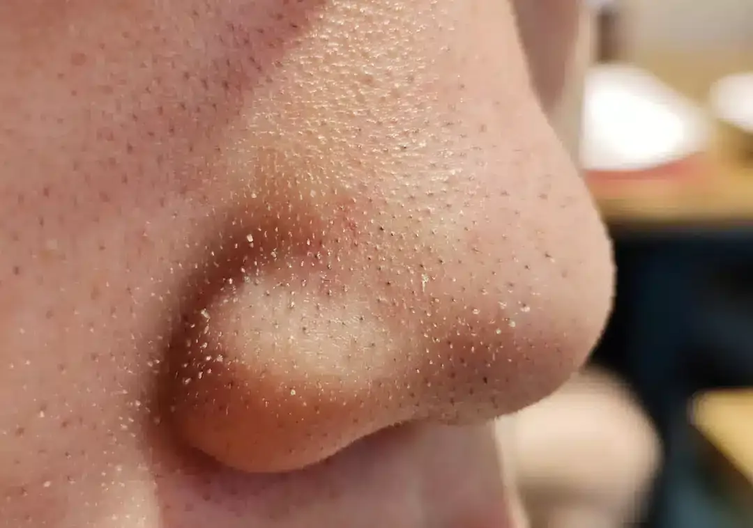 Dermatologista alerta para não espremer os pontinhos pretos