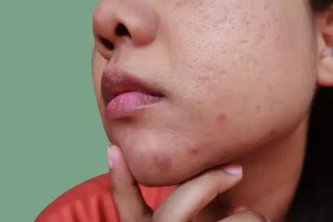 Dermatologista diz que existe um tipo de espinha que você nu