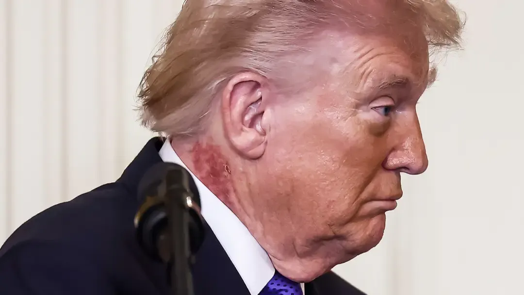 Donald Trump gera novas preocupações com a saúde após aparec