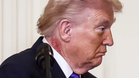 Donald Trump gera novas preocupações com a saúde após aparec