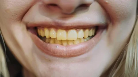 Escovar os dentes antes ou depois do café da manhã?