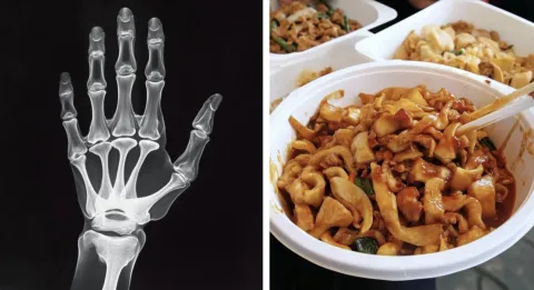Estudante perdeu todos os membros após comer restos de comid