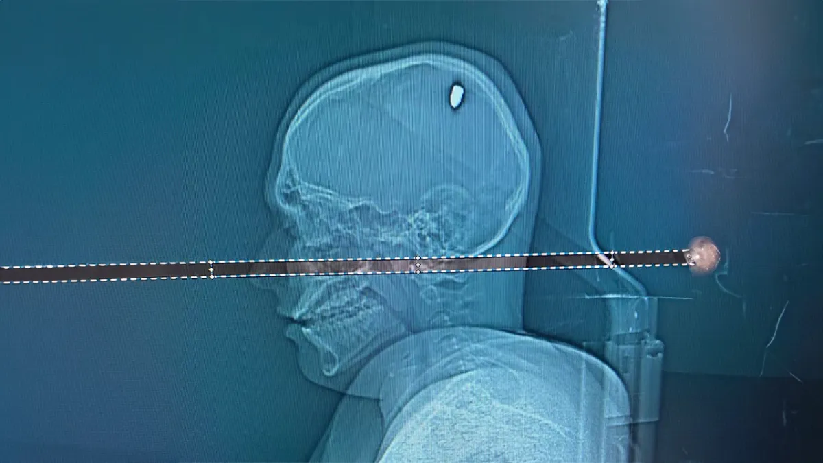 Homem demora dias para notar que levou tiro na cabeça