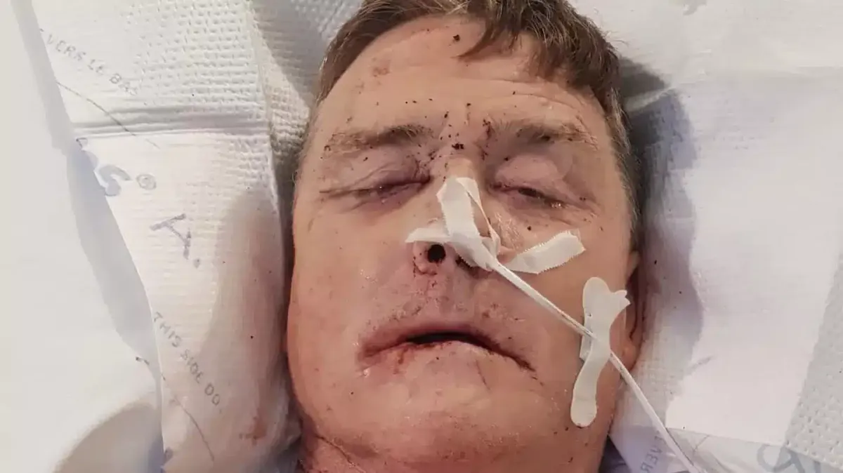 Homem diagnosticado com câncer de boca revela um sinal incom