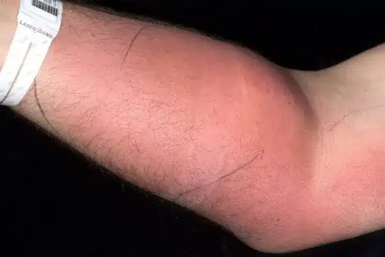 Homem enfrentou consequências perturbadoras após injetar seu