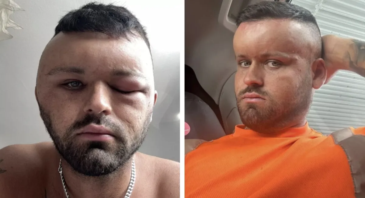 Homem ficou parecendo ‘Megamente’ depois de ter uma reação t