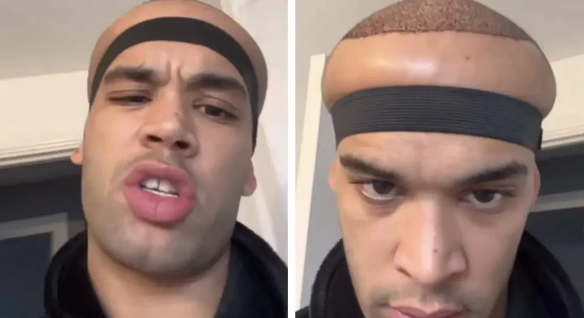 Homem que fez transplante capilar em clínica de celebridades
