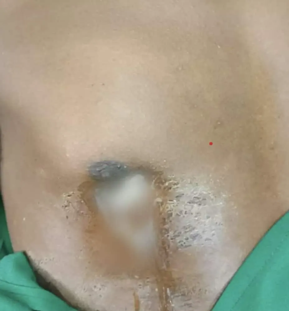 Homem que foi ao hospital após mamilo vazar pus tinha uma fa