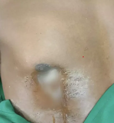 Homem que foi ao hospital após mamilo vazar pus tinha uma fa