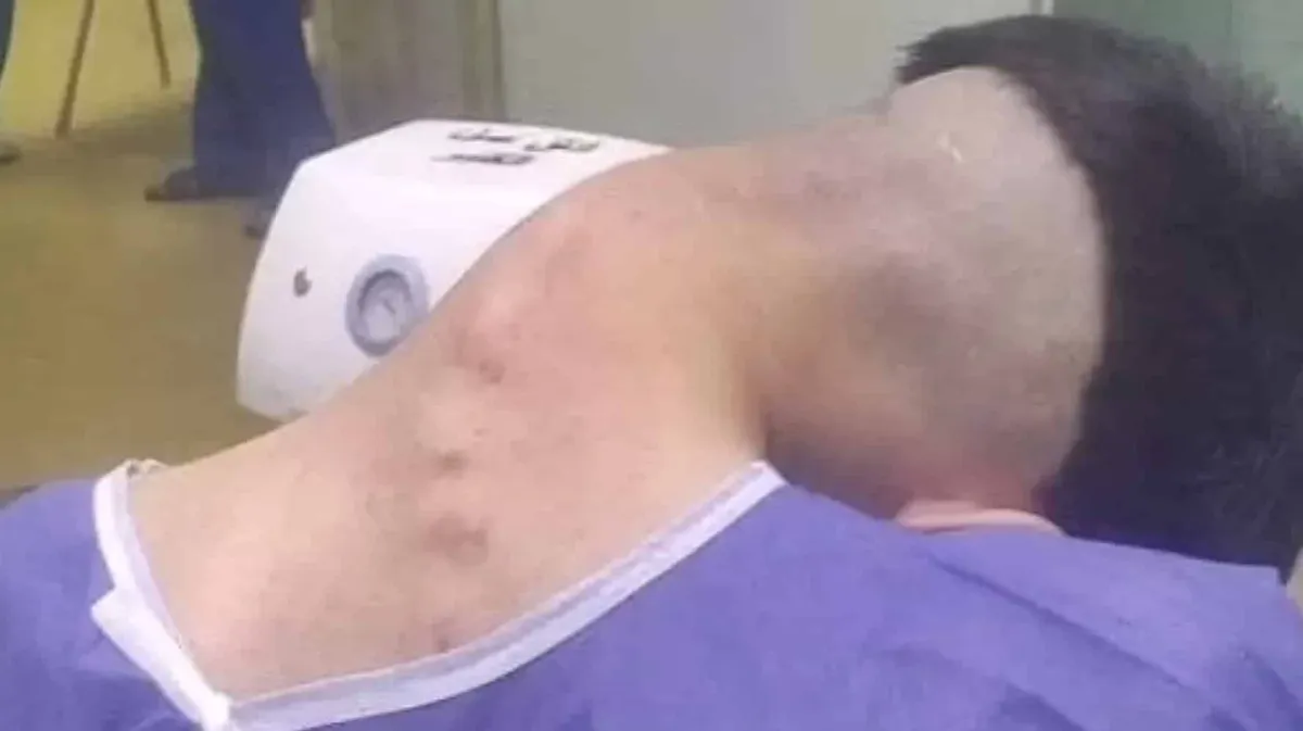 Homem sofre de rara síndrome da cabeça caída causada por víc