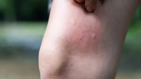 Mãe de 33 anos faz alerta após perceber que uma “picada de m