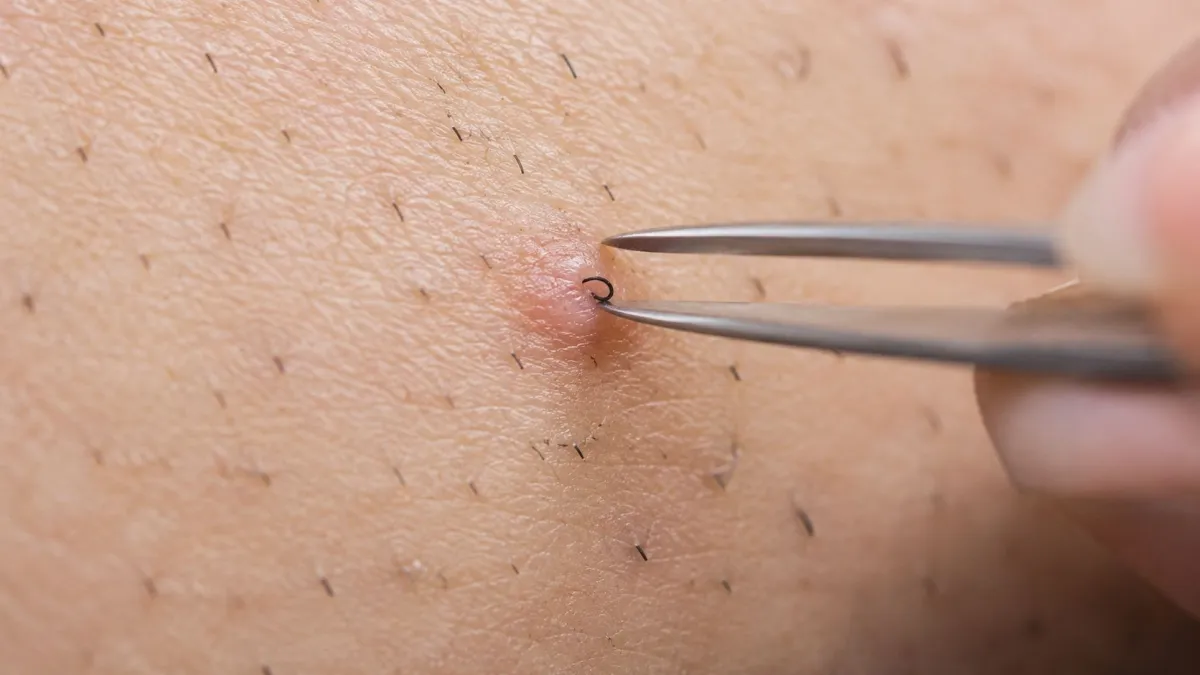 Médico alerta sobre os perigos de arrancar pelos encravados