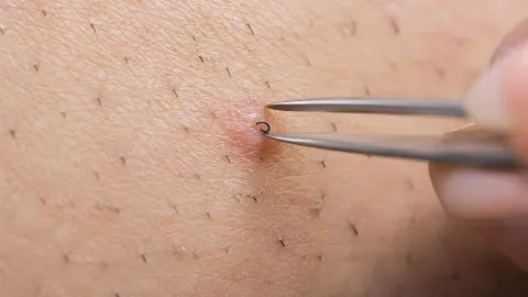 Médico alerta sobre os perigos de arrancar pelos encravados