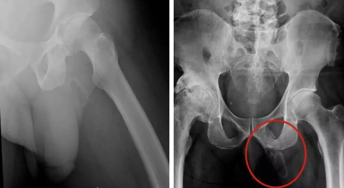Médicos descobrem que pênis de homem está se transformando e