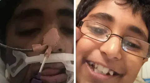 Menino de 13 anos com alergia grave morreu após ter um pedaç