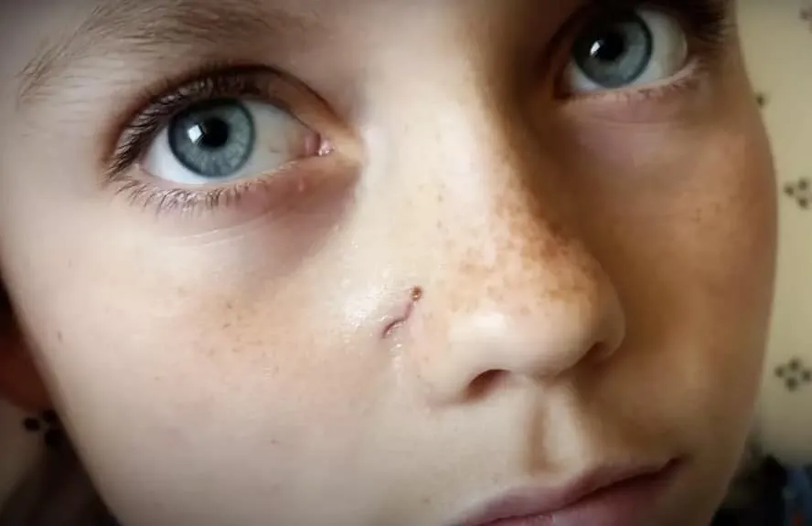 Menino de 9 anos remove flecha após ela atravessar seu céreb