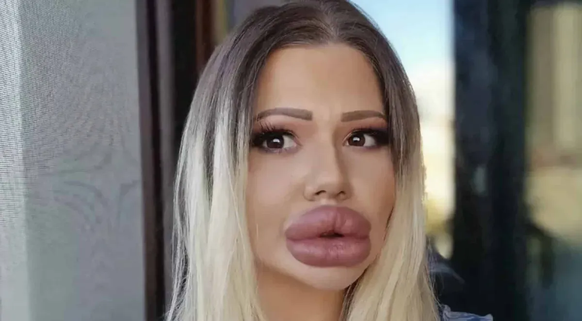 Mulher com os maiores lábios do mundo mostra como era antes
