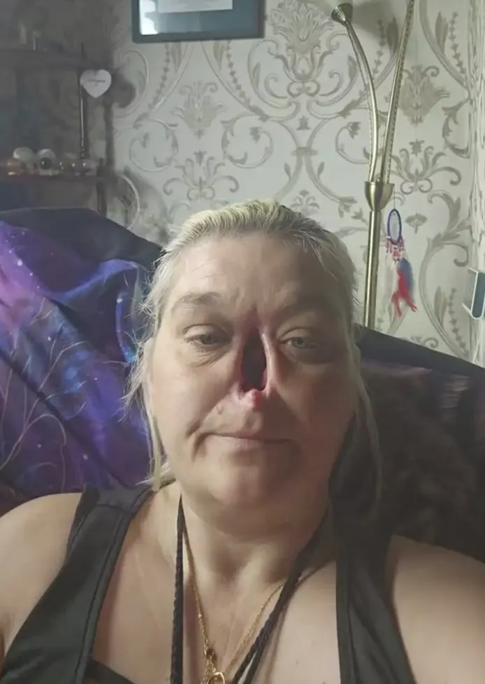 Mulher fica sem nariz após pensar que sangramentos nasais er