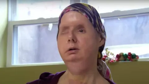 Mulher que teve o rosto arrancado por chimpanzé de estimação