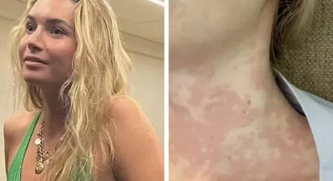 Mulher sofre de condição rara que faz com que beijar alguém 