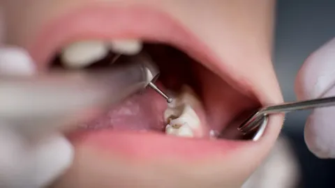 Não é o açúcar: A verdadeira razão pela qual você tem cáries