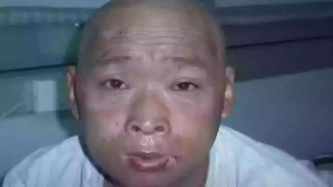 O “homem radioativo” teve apenas um órgão intacto após uma m