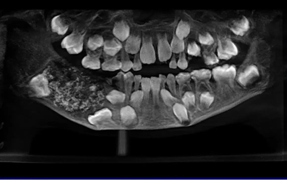 O incrível caso do menino de quem foram extraídos 526 dentes