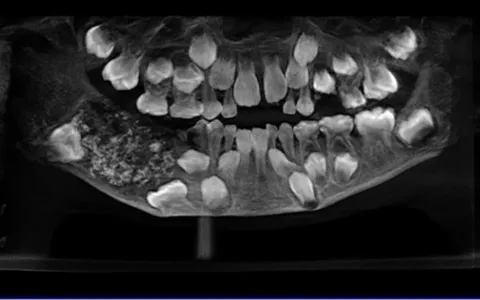 O incrível caso do menino de quem foram extraídos 526 dentes
