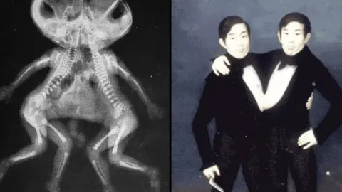 O que acontece se um gêmeo siamês morrer, mas o outro não?