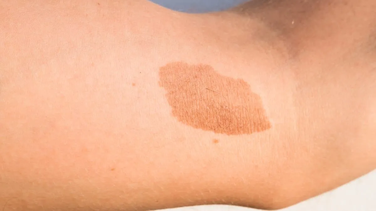 O que significa ter uma marca de nascença no corpo?