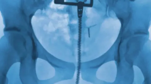 Pessoas chocadas ao descobrir detalhe perturbador que raio-X