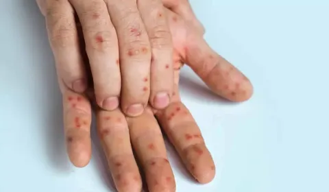 Pessoas são alertadas sobre o primeiro sintoma de mpox que p