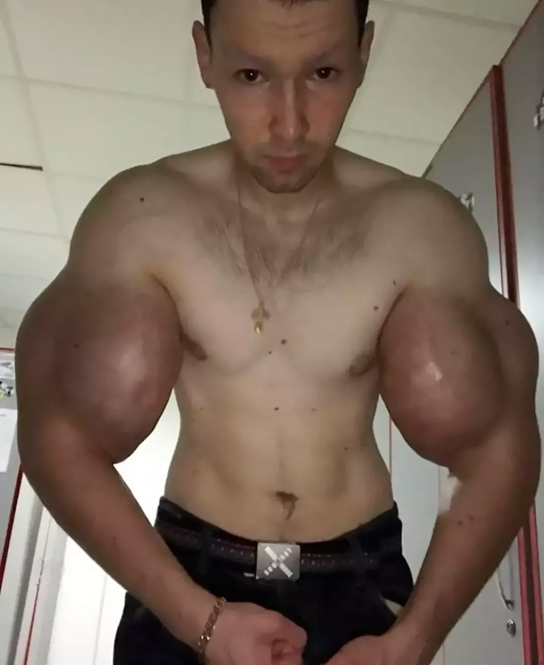 “Popeye” russo pode perder os dois braços depois de injetar