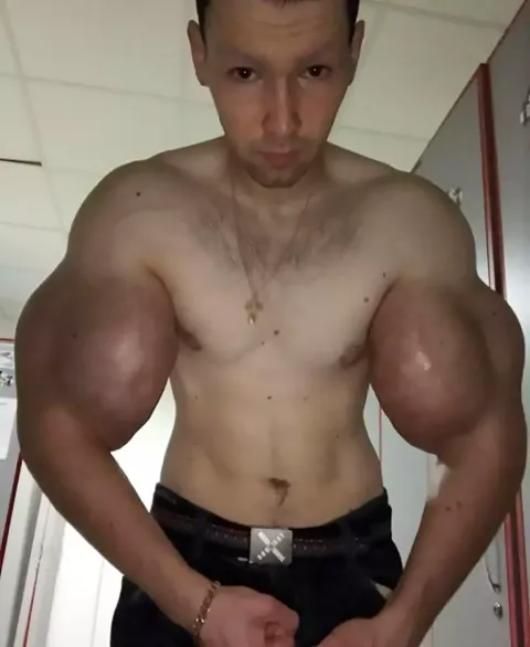 “Popeye” russo pode perder os dois braços depois de injetar geleia de petróleo neles