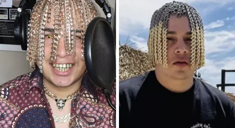 Rapper enfrenta riscos graves após implantar correntes de ouro na cabeça para parecer cabelo