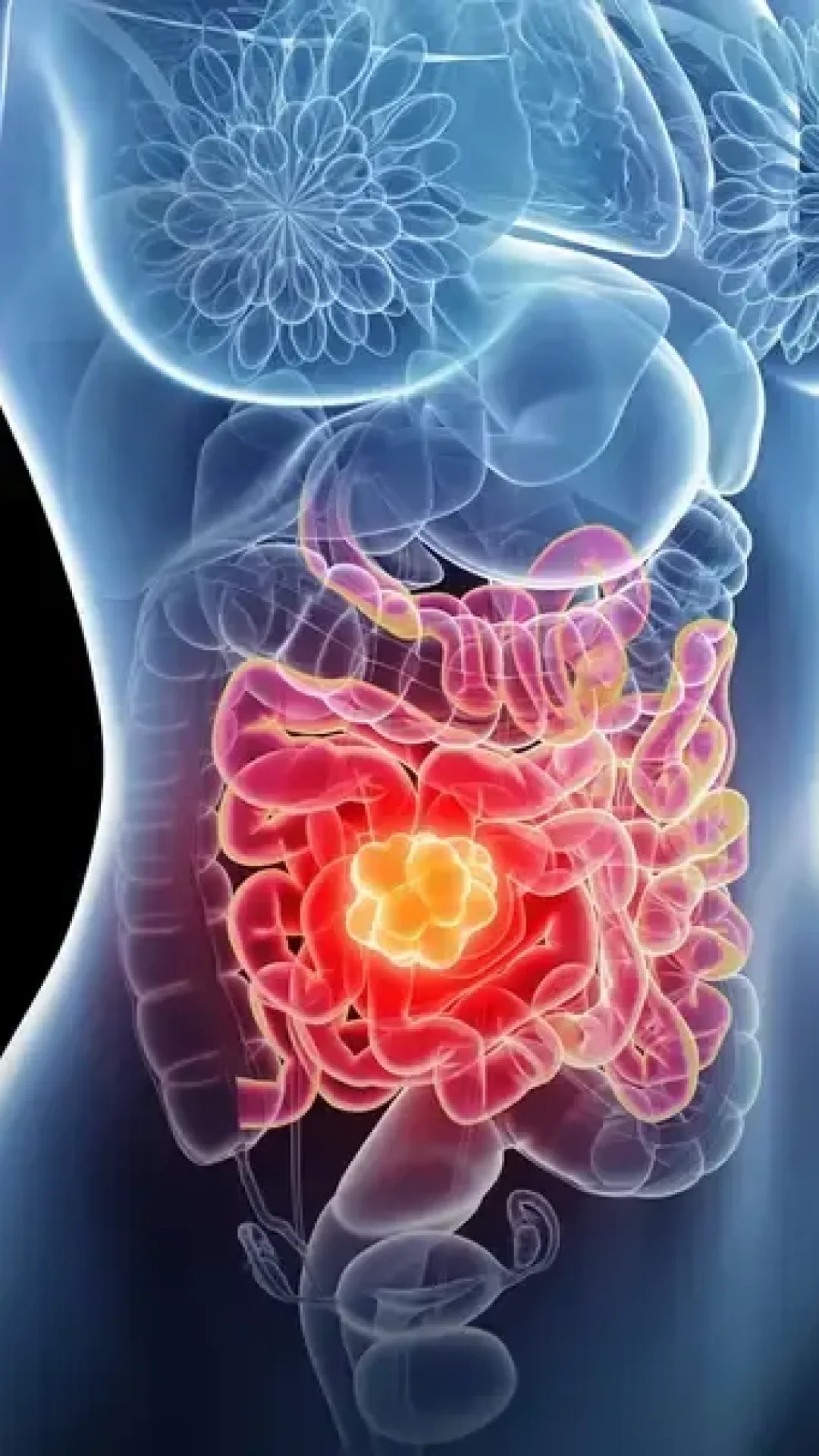 A dieta “pior que fumar” que pode aumentar o risco de câncer intestinal