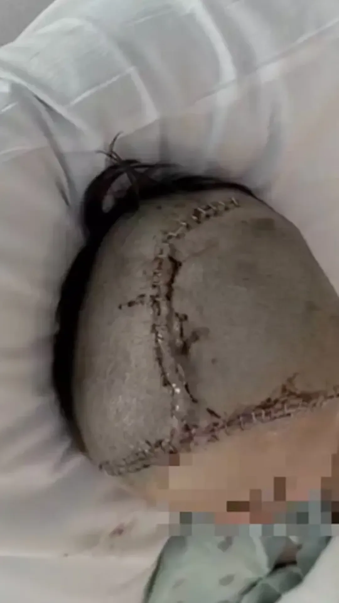 Adolescente atacado por colega após fazer uma piada tem a cabeça reconstruída enquanto a família divulga uma atualização chocante