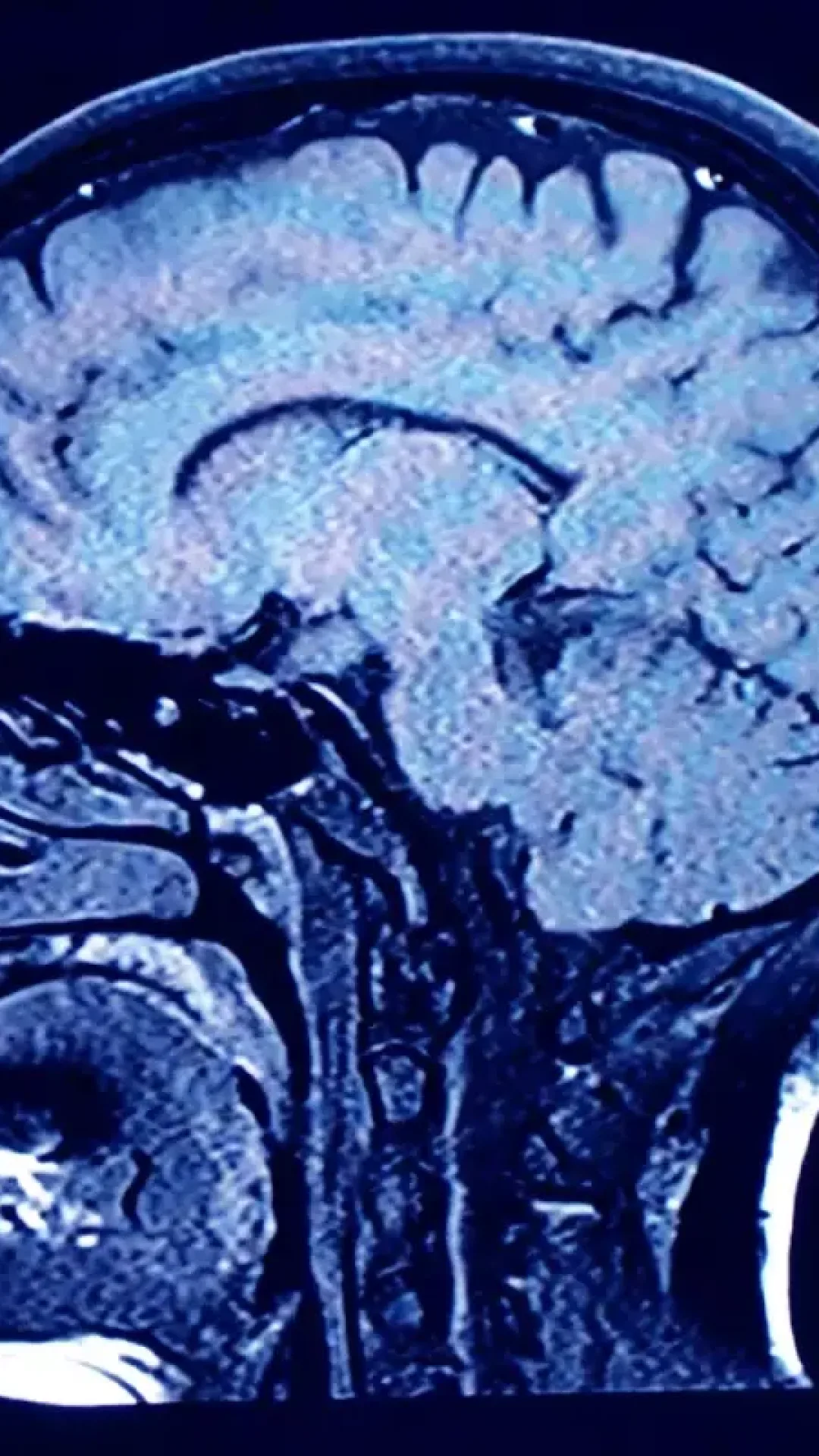 Cientistas gravam cérebro humano durante a morte e fazem uma revelação incrível