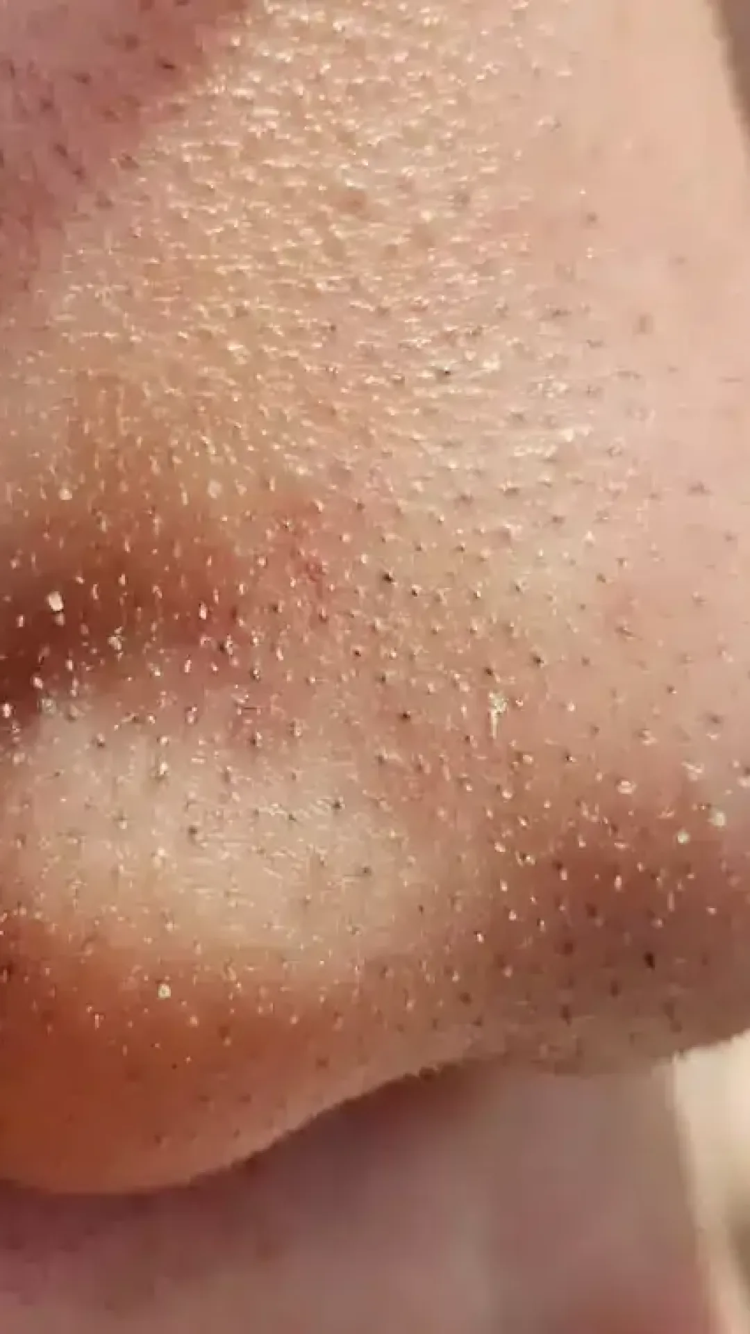 Dermatologista alerta para não espremer os pontinhos pretos do nariz porque eles não são o que você pensa