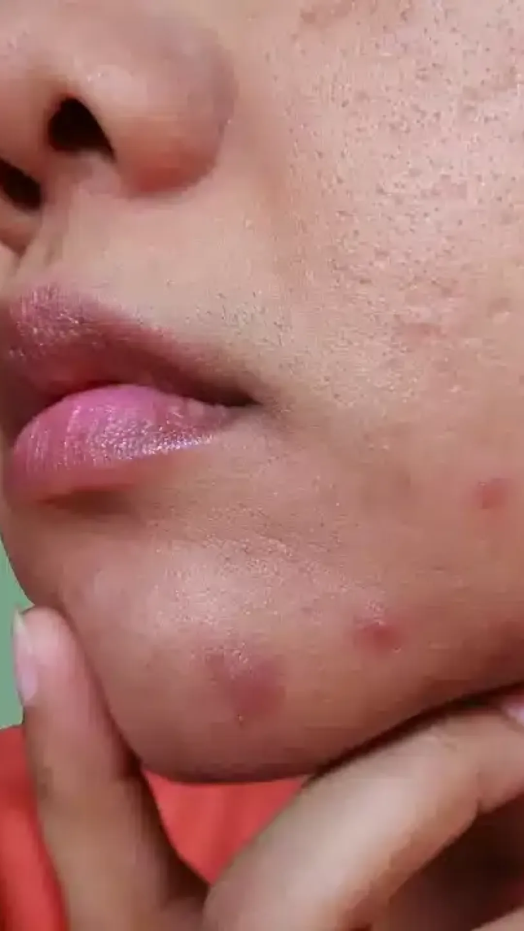 Dermatologista diz que existe um tipo de espinha que você nunca deve espremer no rosto