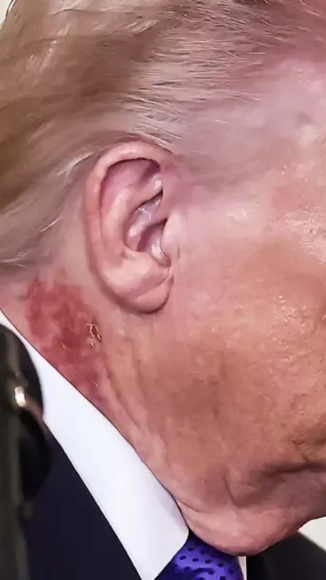 Donald Trump gera novas preocupações com a saúde após aparecer com uma erupção com crostas no pescoço