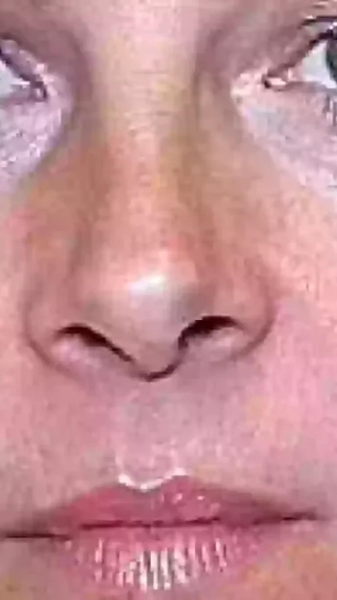 Gêmeas idênticas apresentam diferença marcante após uma usar botox por 20 anos e a outra não
