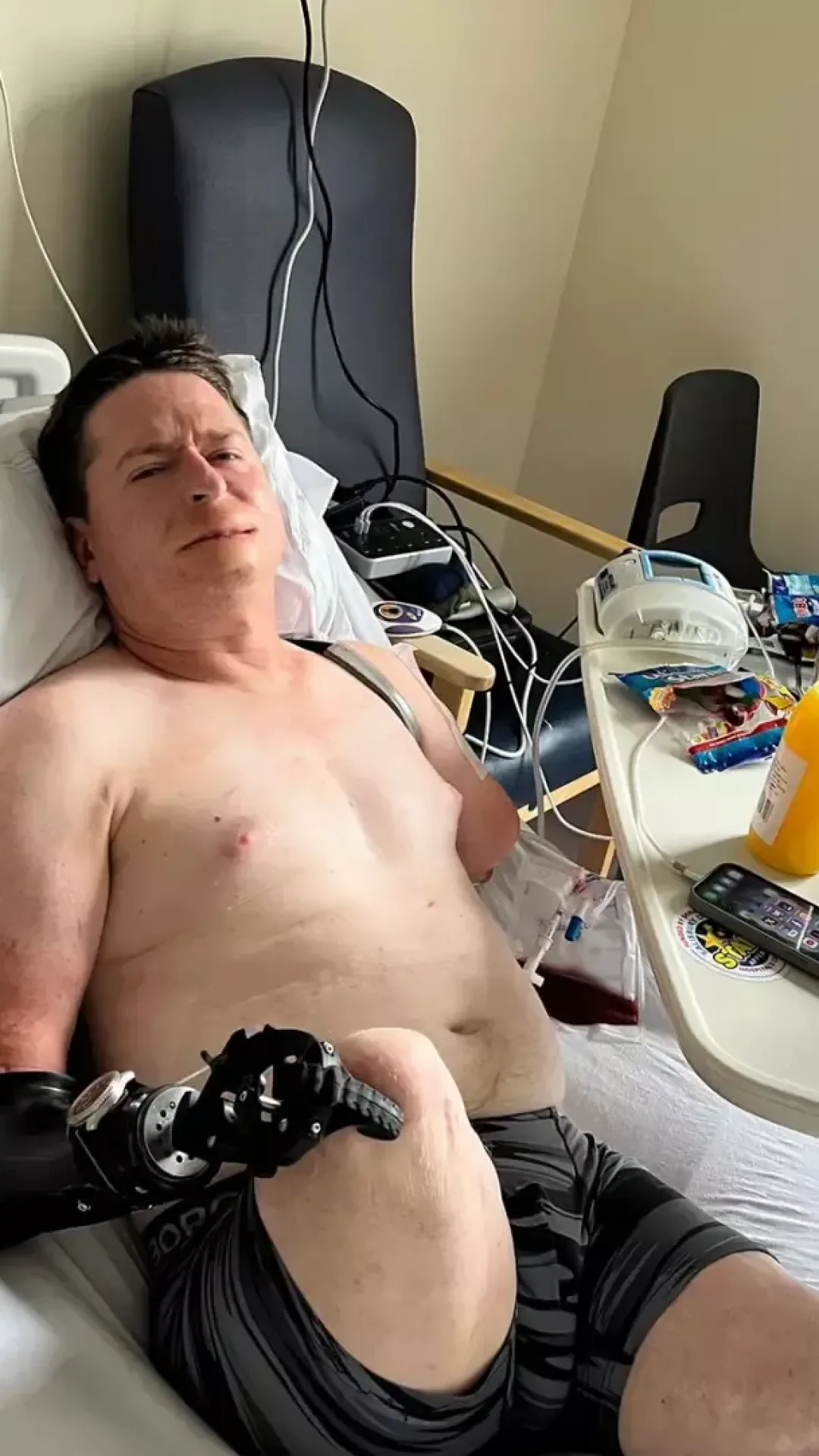 Homem achou que tinha sintomas de gripe, mas acabou precisando amputar todos os membros