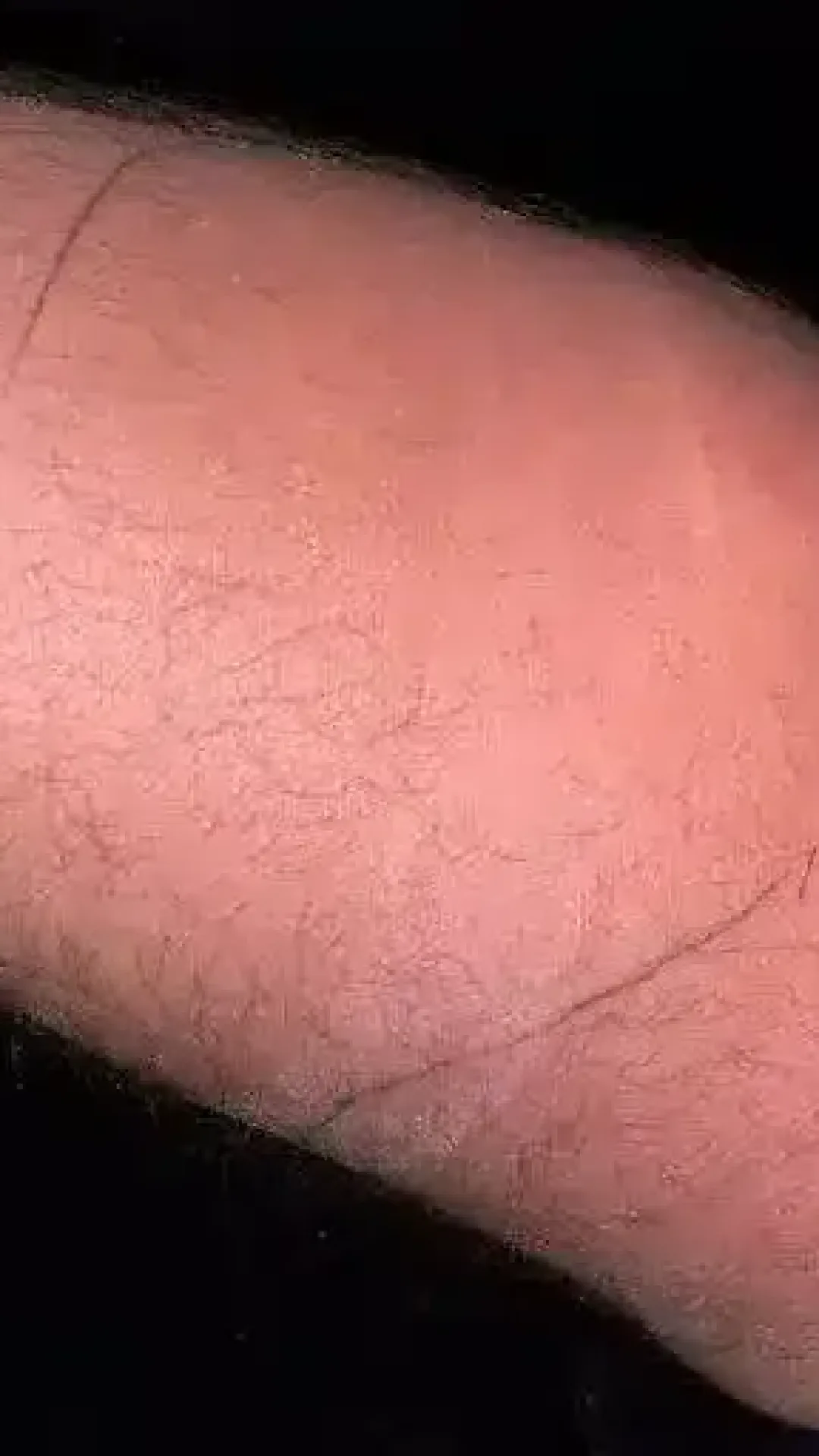 Homem enfrentou consequências perturbadoras após injetar seu próprio esperma para tratar dor crônica nas costas