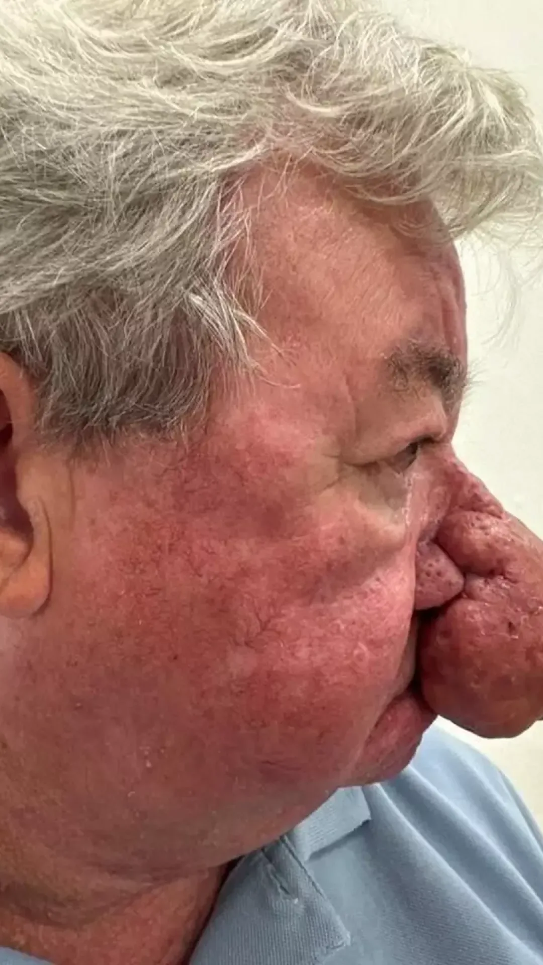 Homem fica incapaz de beijar a esposa após um dos piores casos de crescimento nasal já vistos por médicos