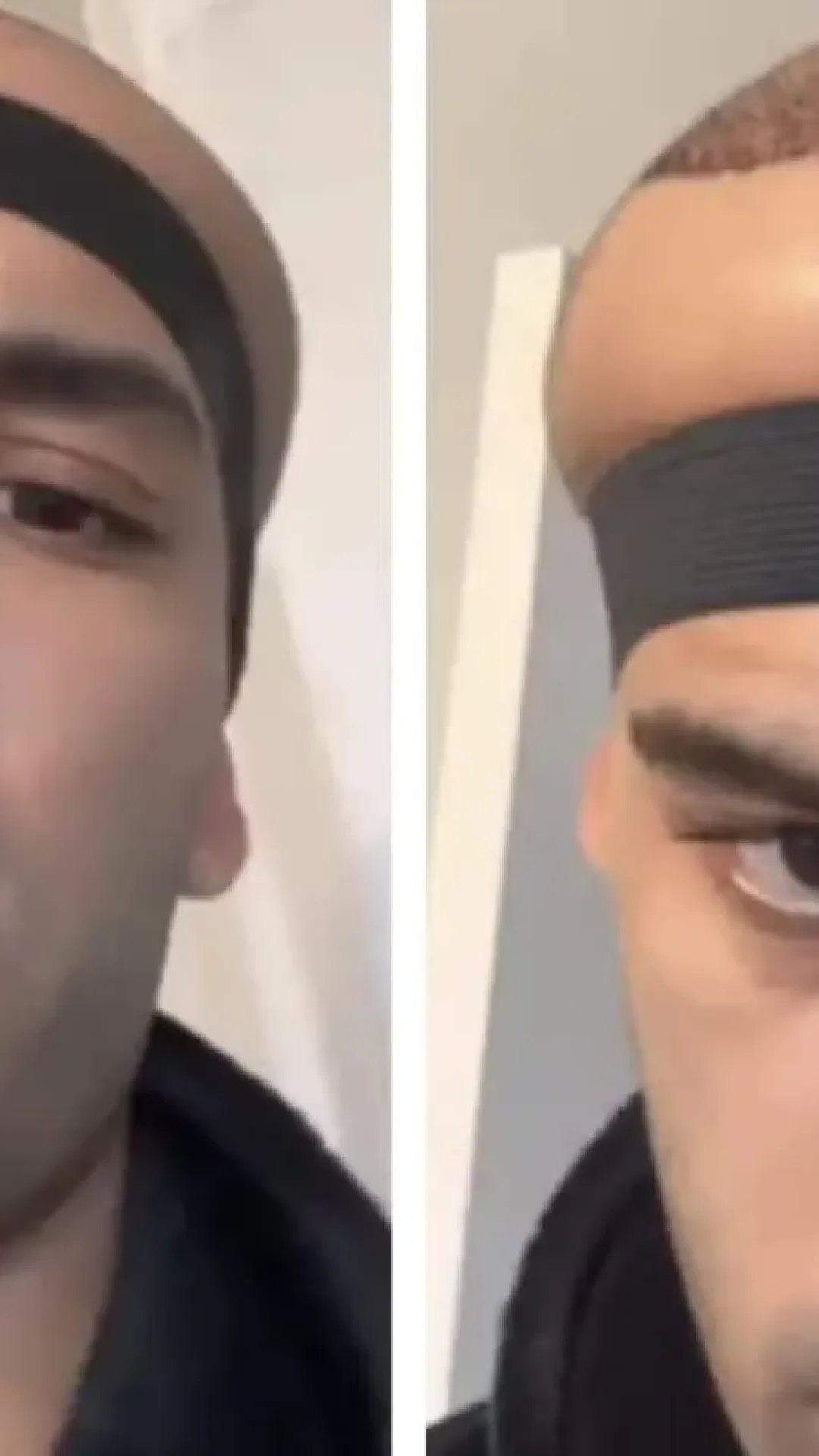 Homem que fez transplante capilar em clínica de celebridades revela resultados e é comparado ao “Megamente” por internautas